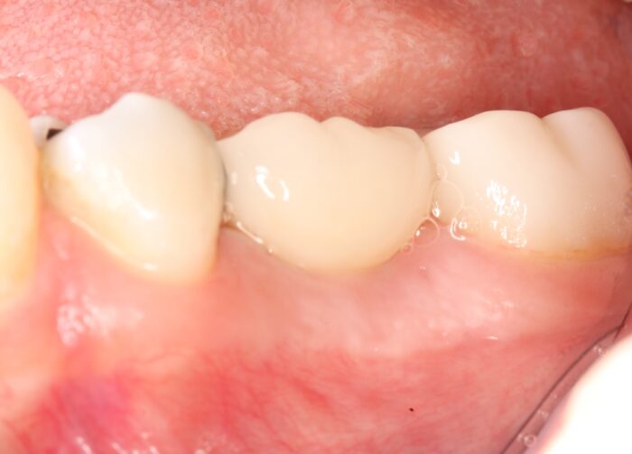 After image of a healed zirconia dental implant placed by Dr. Monzavi.