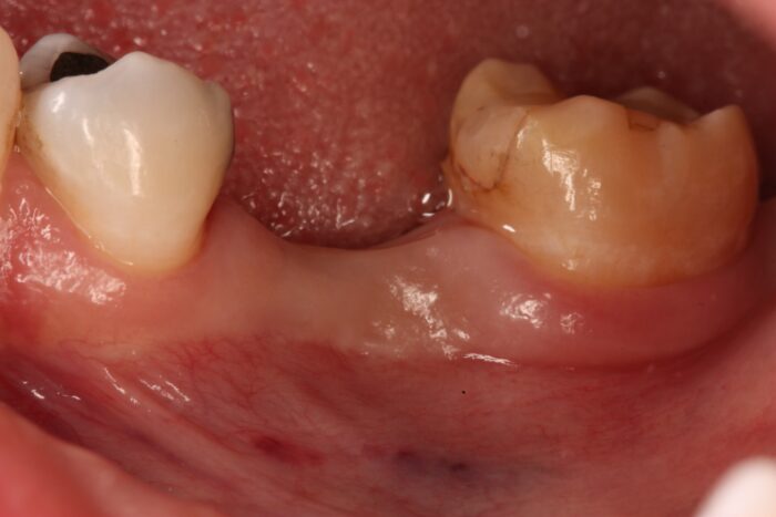 before image of patient with a tooth extraction in need of a zirconia dental implant
