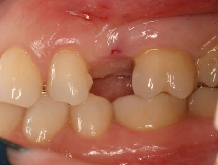 before image of patient with extracted tooth in need of a zirconia dental implant