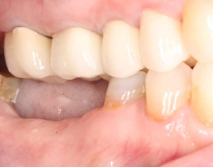 before image of a patient with two missing teeth in need of a ceramic dental implant