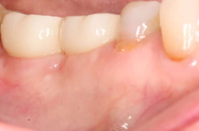 After image of two healed ceramic dental implants placed by Dr. Monzavi.