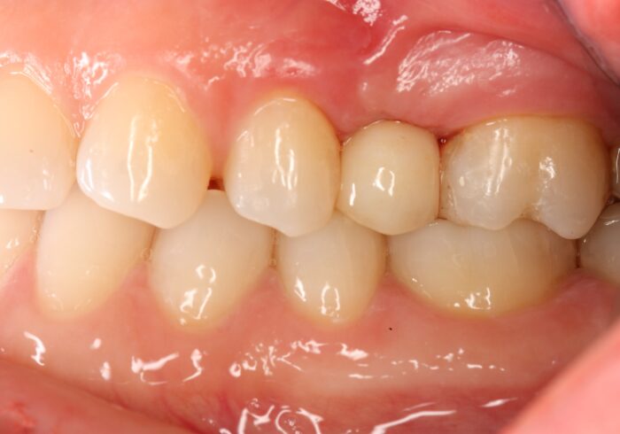 After image of a completed and healed zirconia dental implant procedure performed by Dr. Monzavi.