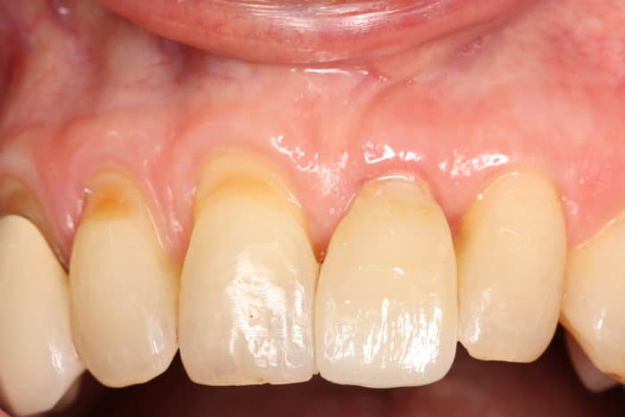 After image of the completed and healed ceramic dental implant placed by Dr. Monzavi.