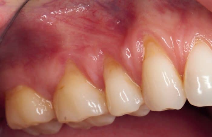 Before image of a patient in need of a connective tissue graft.