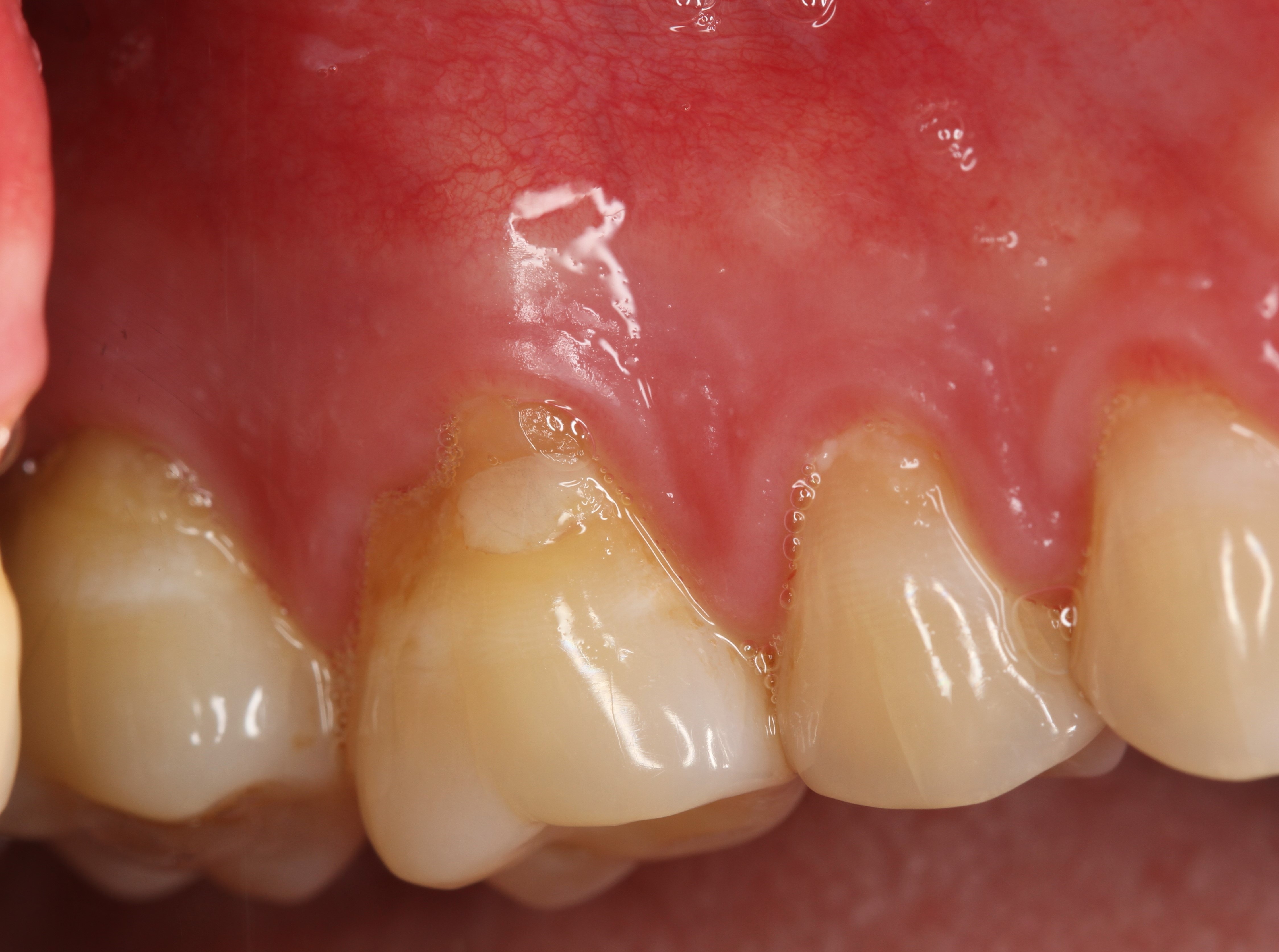 before image of a patient in need of a connective tissue procedure