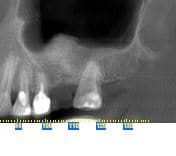 After x-ray of a sinus graft procedure performed by Dr. Monzavi