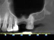 Before x-ray of a sinus graft procedure done by Dr. Monzavi