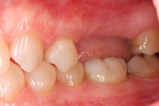 mona monzavi missing tooth patient before picture