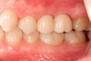 mona monzavi ceramic implant on missing tooth after picture