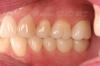 after image of mona monzavi ceramic implant patient