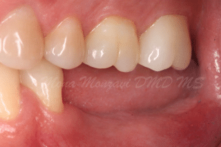 before image of mona monzavi ceramic implant patient